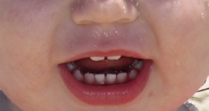 Baby teeth